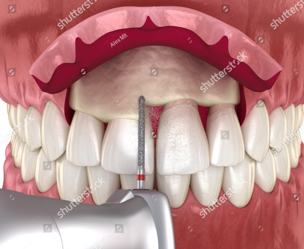 Diagnostics,Gum Disease Treatment,Dental Implants,Perioplastic Surgery,Oral Medicine,Teeth Cleaning,Conscious Sedation,Periodontist,Periodontist Dental Implant Specialist,Gum disease treatment near me,Periodontal disease,Bleeding gums causes,Gum disease specialist South Africa,Gum surgery Johannesburg,Pocket reduction surgery Johannesburg,Scaling and root planing Johannesburg,Gingivitis treatment Johannesburg,Tooth loss prevention dentist,Non-surgical gum disease treatment