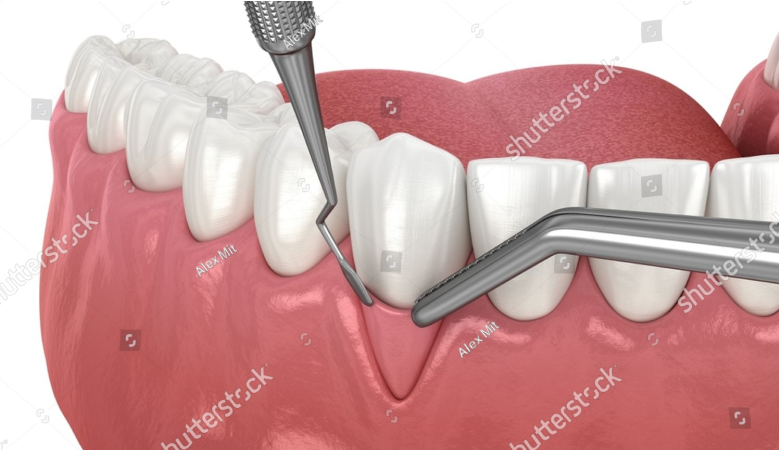 Diagnostics,Gum Disease Treatment,Dental Implants,Perioplastic Surgery,Oral Medicine,Teeth Cleaning,Conscious Sedation,Periodontist,Periodontist Dental Implant Specialist,Gum Recession Treatment Johannesburg,Sensitive Teeth Gum Recession,Exposed Tooth Roots Treatment,Gum Graft Surgery Johannesburg,Gum Recession Coverage South Africa