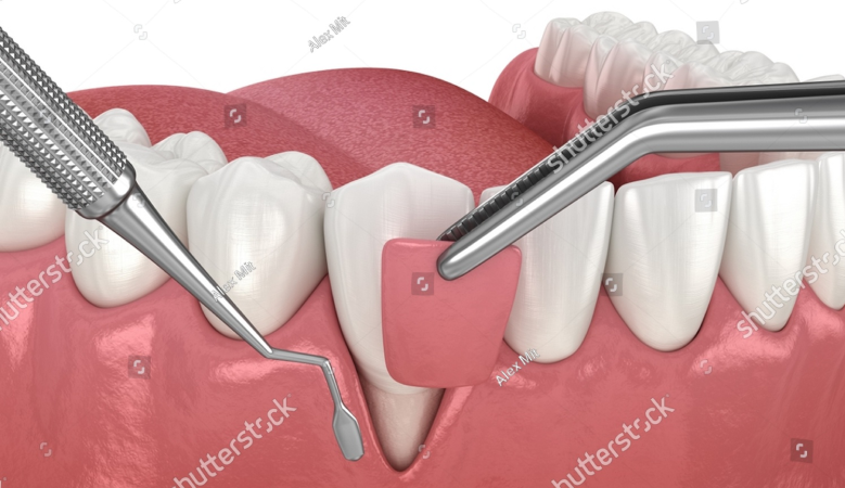 Diagnostics,Gum Disease Treatment,Dental Implants,Perioplastic Surgery,Oral Medicine,Teeth Cleaning,Conscious Sedation,Periodontist,Periodontist Dental Implant Specialist,Gum Recession Treatment Johannesburg,Sensitive Teeth Gum Recession,Exposed Tooth Roots Treatment,Gum Graft Surgery Johannesburg,Gum Recession Coverage South Africa