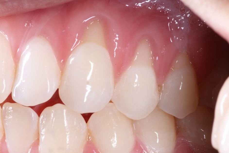 Diagnostics,Gum Disease Treatment,Dental Implants,Perioplastic Surgery,Oral Medicine,Teeth Cleaning,Conscious Sedation,Periodontist,Periodontist Dental Implant Specialist,Gum Recession Treatment Johannesburg,Sensitive Teeth Gum Recession,Exposed Tooth Roots Treatment,Gum Graft Surgery Johannesburg,Gum Recession Coverage South Africa